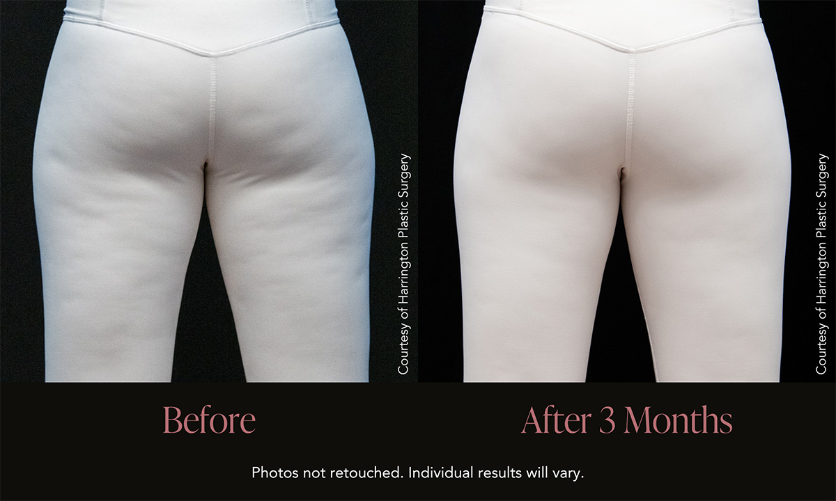 Cellulite Treatment (Aveli)