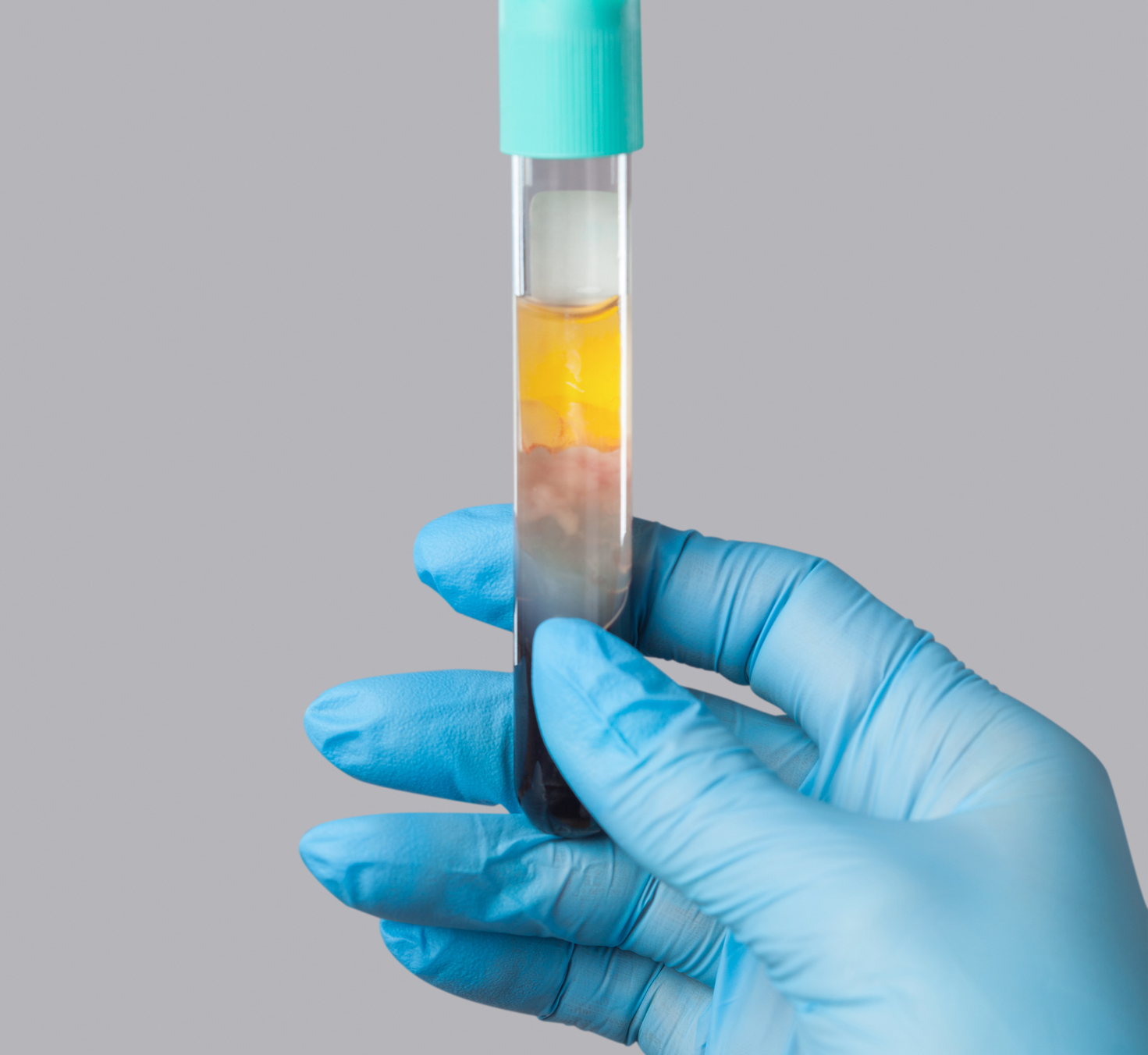 PRP (Platelet-Rich Plasma)