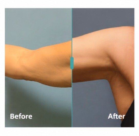 Flabby Arms Treatment in Peoria